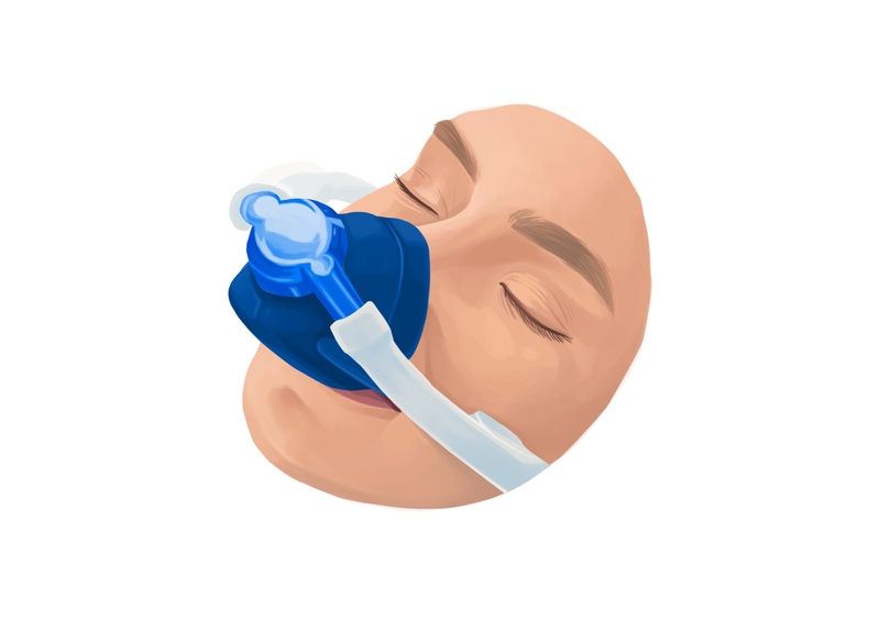 Laughing gas anesthesia