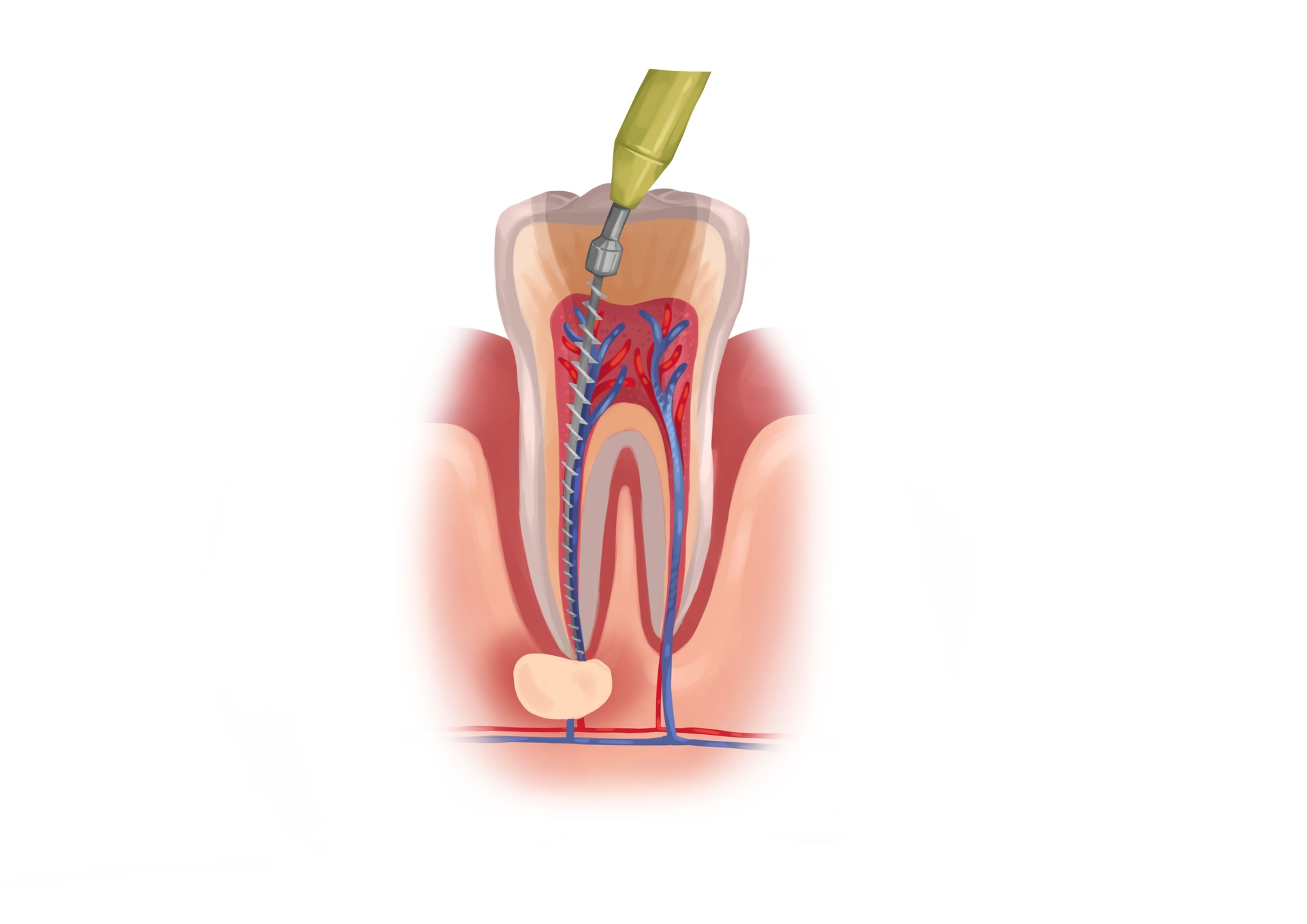 how-much-does-a-root-canal-treatment-cost-in-2024-authority-dental