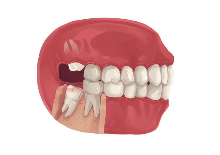 How much is wisdom tooth extraction in 2024? | Authority Dental