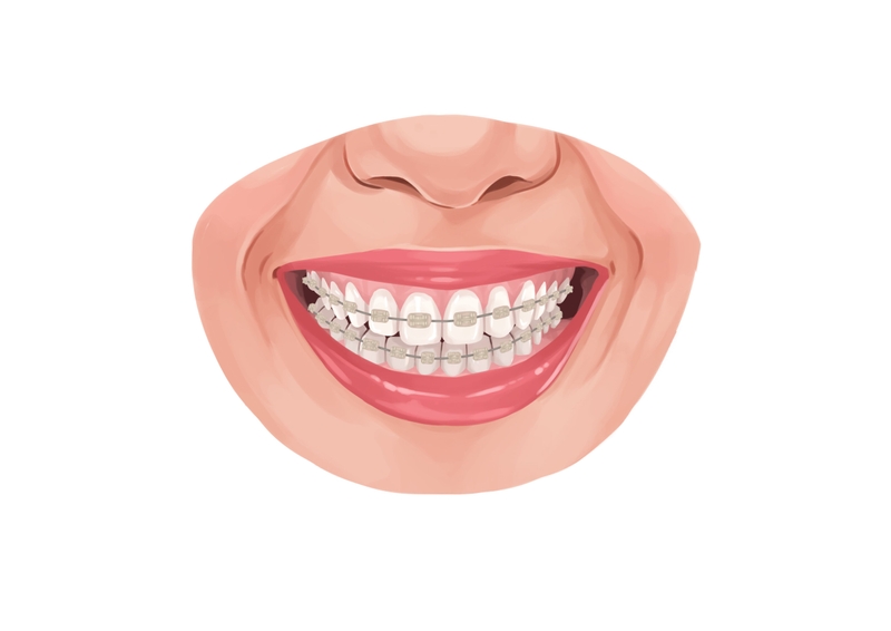 What Is the Cost of Ceramic Braces?