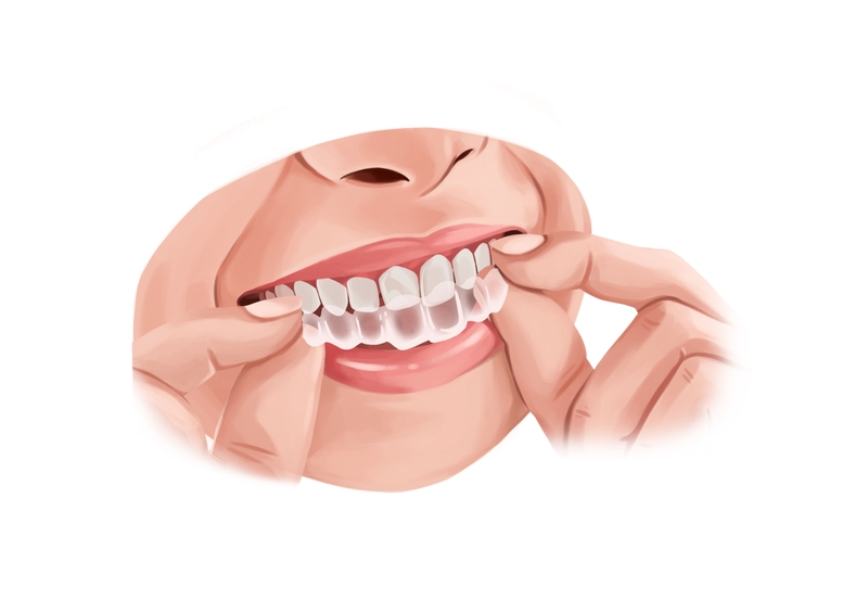  Free Dental Photos Invisalign treatment for a slight malocclusion