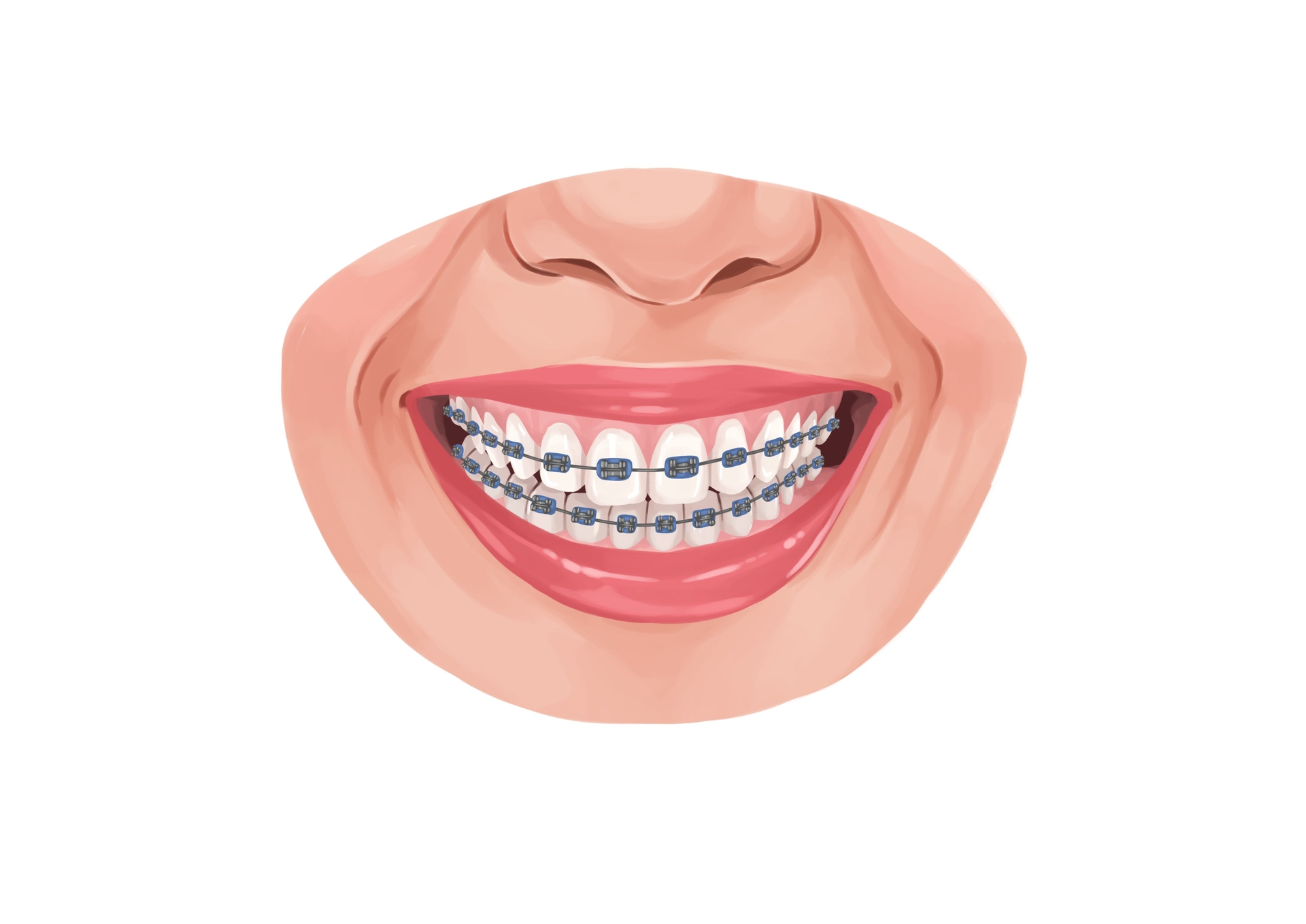 How Much Do Braces Cost In 2024 Authority Dental   Tradition Metal Braces Technical Picture 50729826397 O 