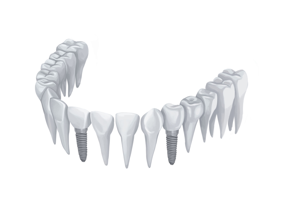 Can You Get Affordable Dental Implants In 2024 Authority Dental   Dental Implants On Lower Arch Without Gums Technical Picture 50730166193 O 